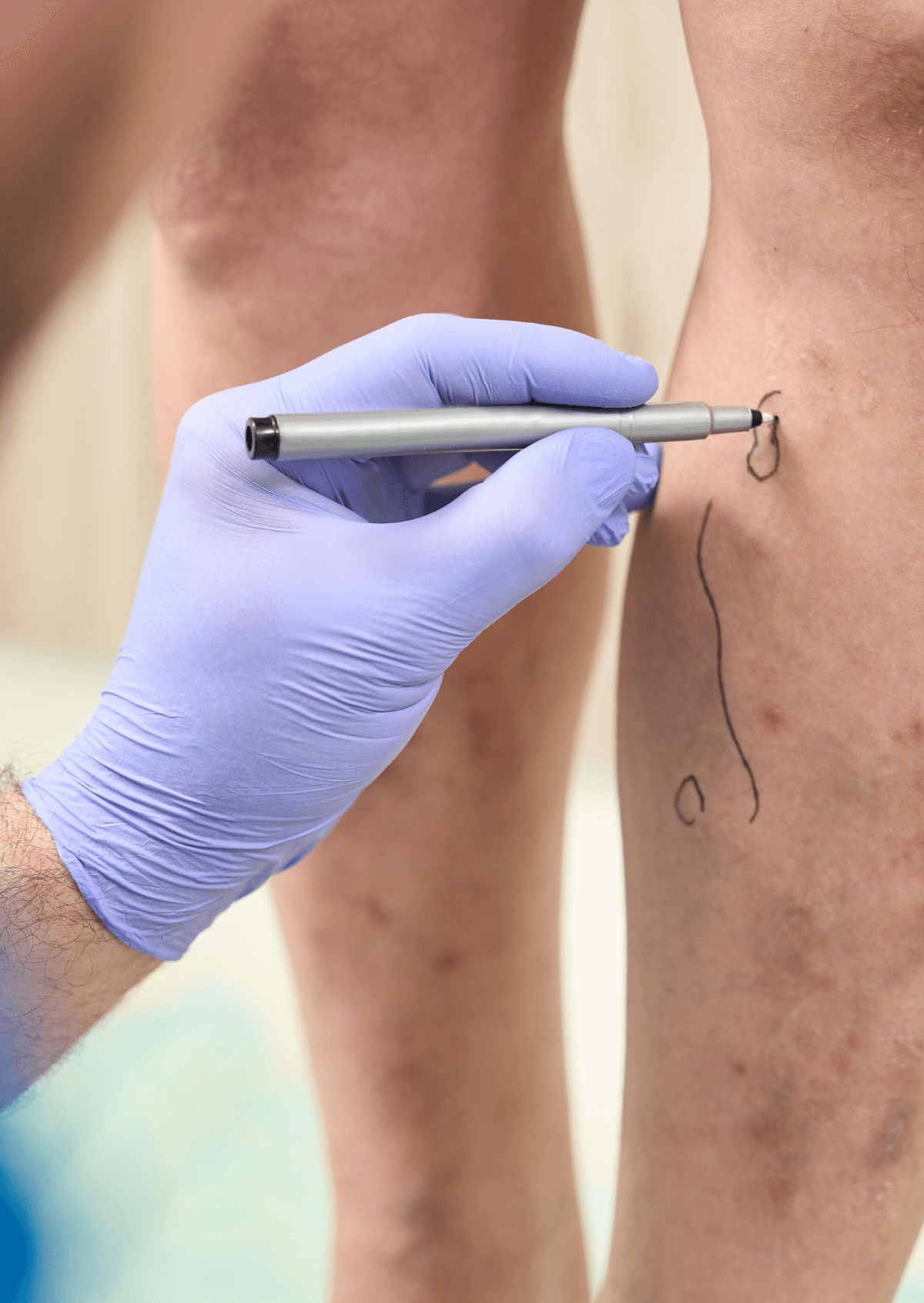 Cirugía de várices